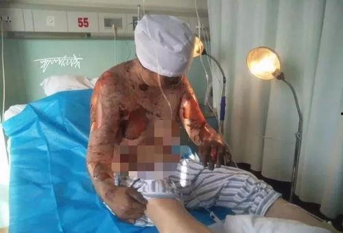 烧伤 视频,紧急救援与康复之路